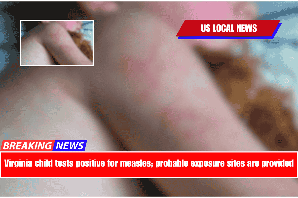 Virginia child tests positive for measles; probable exposure sites are provided